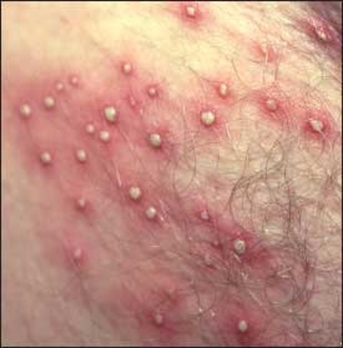 <p>when hair grows under the surface of the skin instead of growing up and out of the follicle, causing a bacterial infection</p>