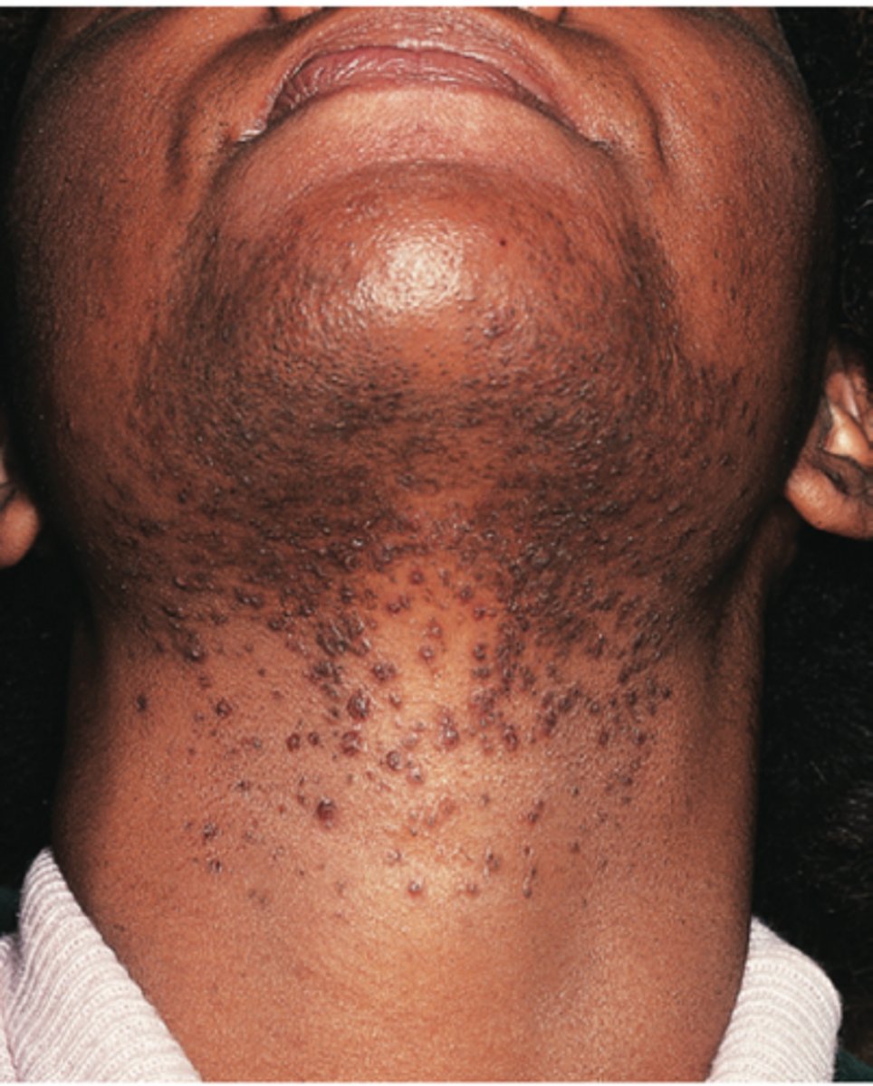<p>Pseudofolliculitis barbae</p>