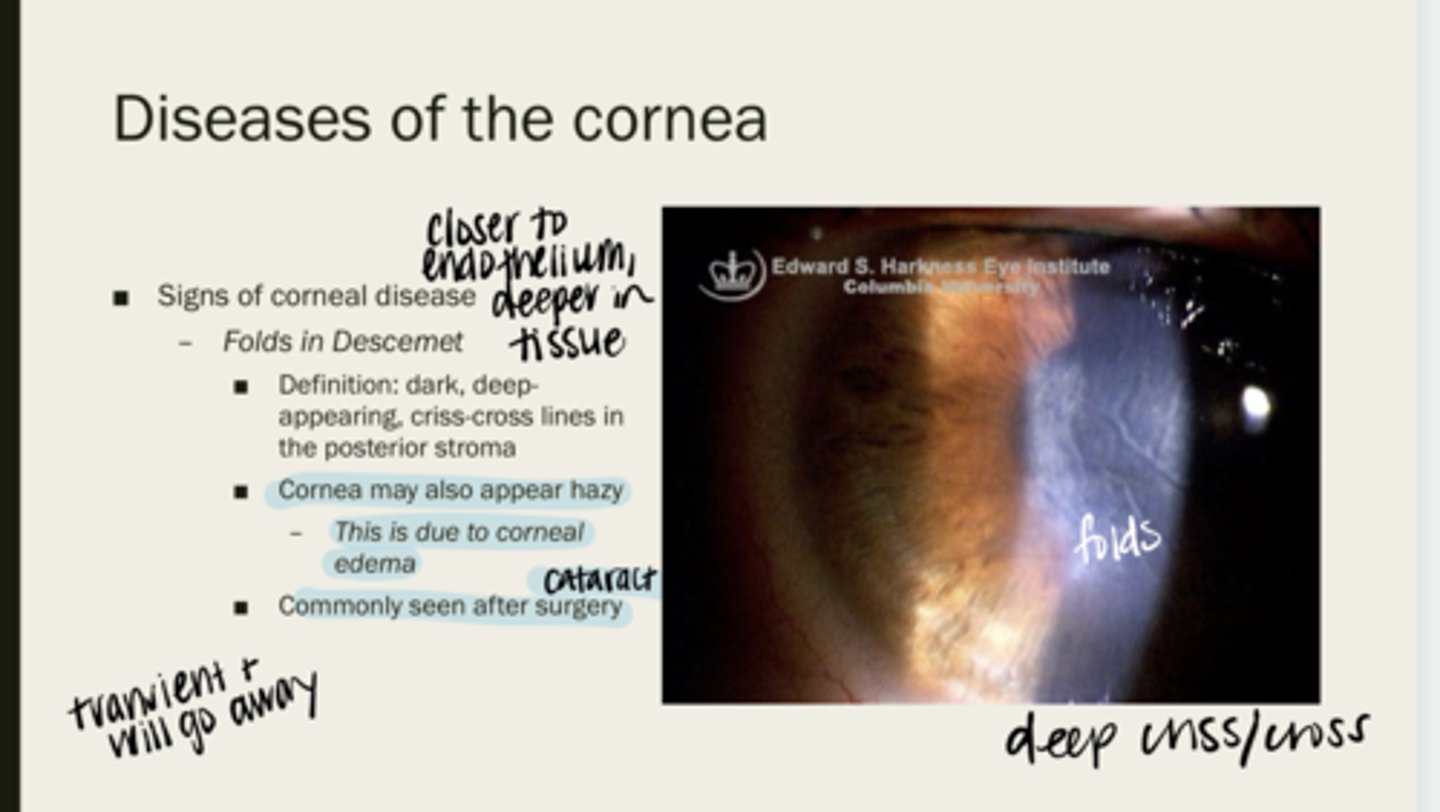 <p>When are folds in Descemet membrane typically seen?</p>
