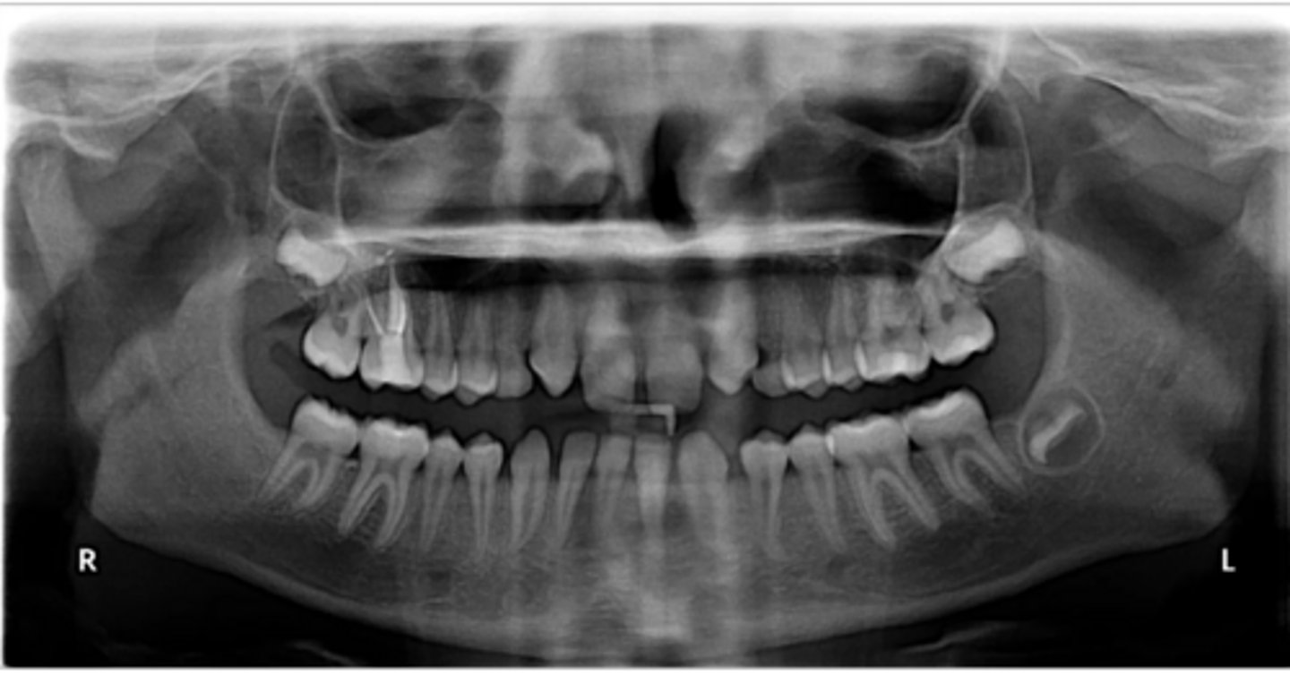 <p>Are there any retained primary teeth?</p>
