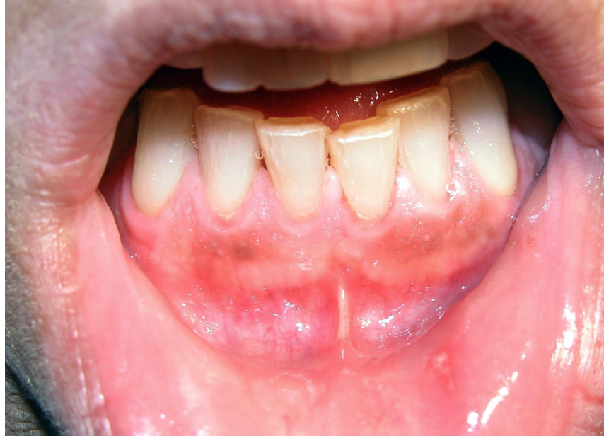 <p>facial gingiva&nbsp;</p>