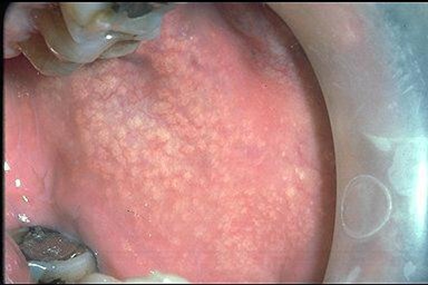 <p>Intraoral sebaceous (oil) glands</p><p>Small, bilateral, yellow nodules of buccal mucosa and vermillion after puberty.</p>