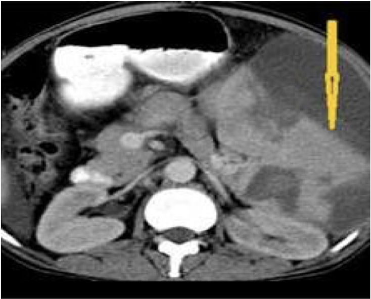 <p><em>CTA Abdomen/Pelvis IV contrast</em></p>