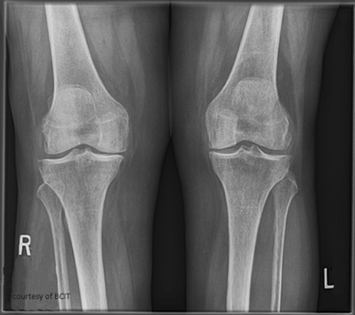 <p>associated with activities that continually stress the joints- a degenerative joint disease. (primary and secondary). this is a normal aging process which occurs gradually, occurs after 40 years of age. cumulative effects activity over time and wears down cartilage. symptoms are stiffness, pain from loss of cartilage, decreased mobility. images show a narrowing of joint spaces, osteophytes may be present. Pain killers and lifestyle changes are encouraged for conservative treatment, joint replacement surgery may be an option</p>