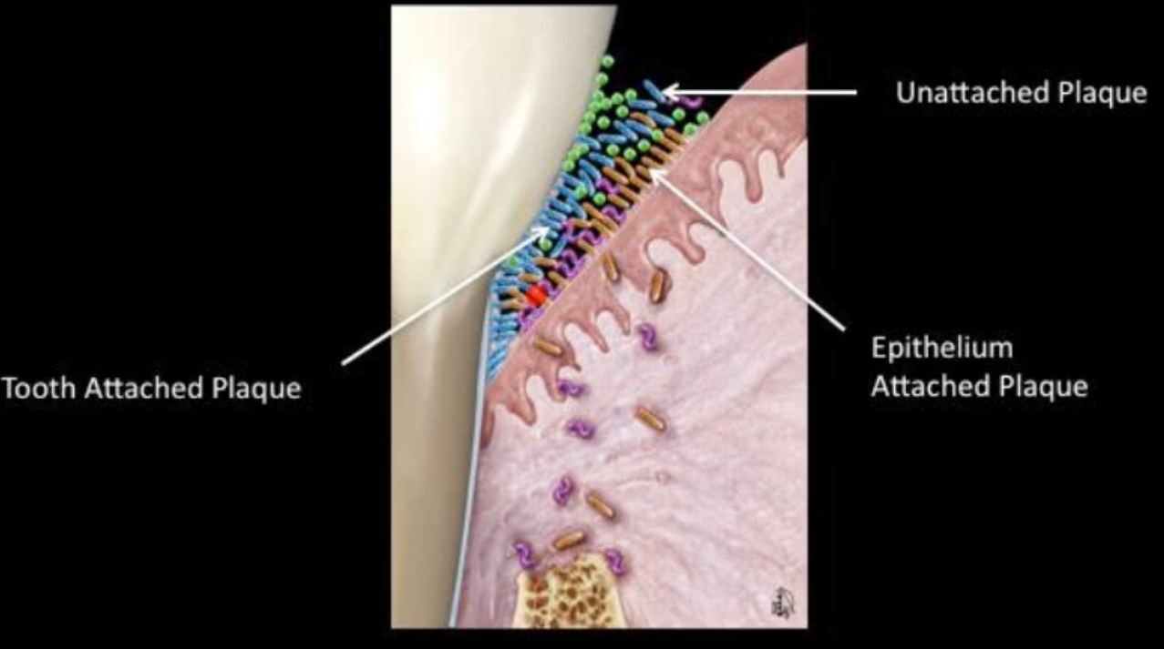 <ul><li><p>Unattached plaque</p></li><li><p>epithelium attached plaque</p></li><li><p>tooth attached plaque</p></li></ul><p></p>