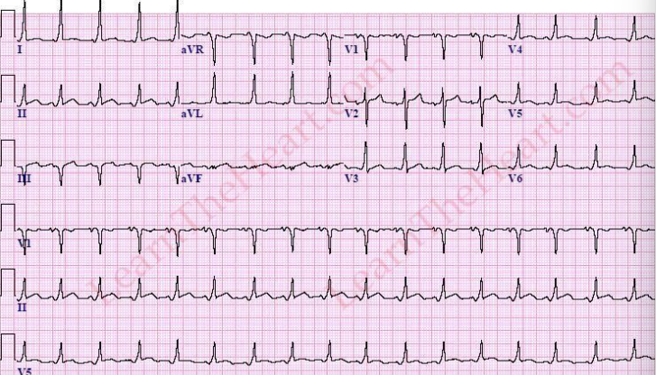 <p>what causes a delta wave/slurring upstroke in an EKG?</p>