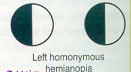 <p>If a patient presented with this focal deficit, where would you expect to find a lesion?</p>