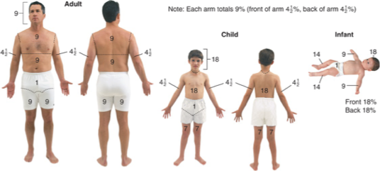 <p>TBSA is calculated only based on percent of second- and third-degree burns – First</p><p class="p1">degree/superficial burns are not included in this calculation</p>
