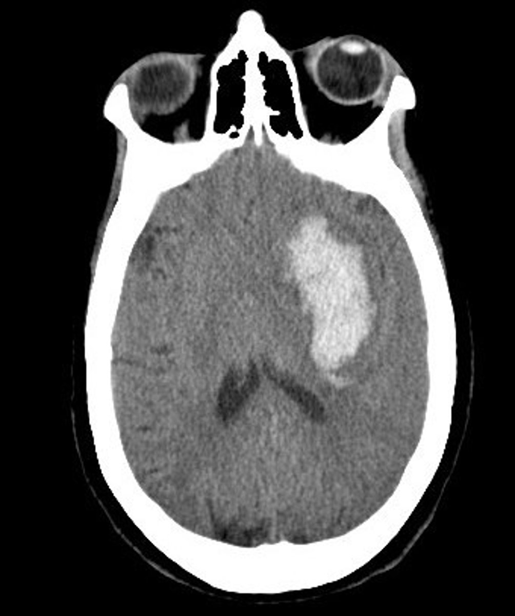 <p>occurs when a blood vessel in the brain leaks or ruptures; also known as a bleed</p><p>- lower fat intake</p><p>- can cause epilepsy</p>