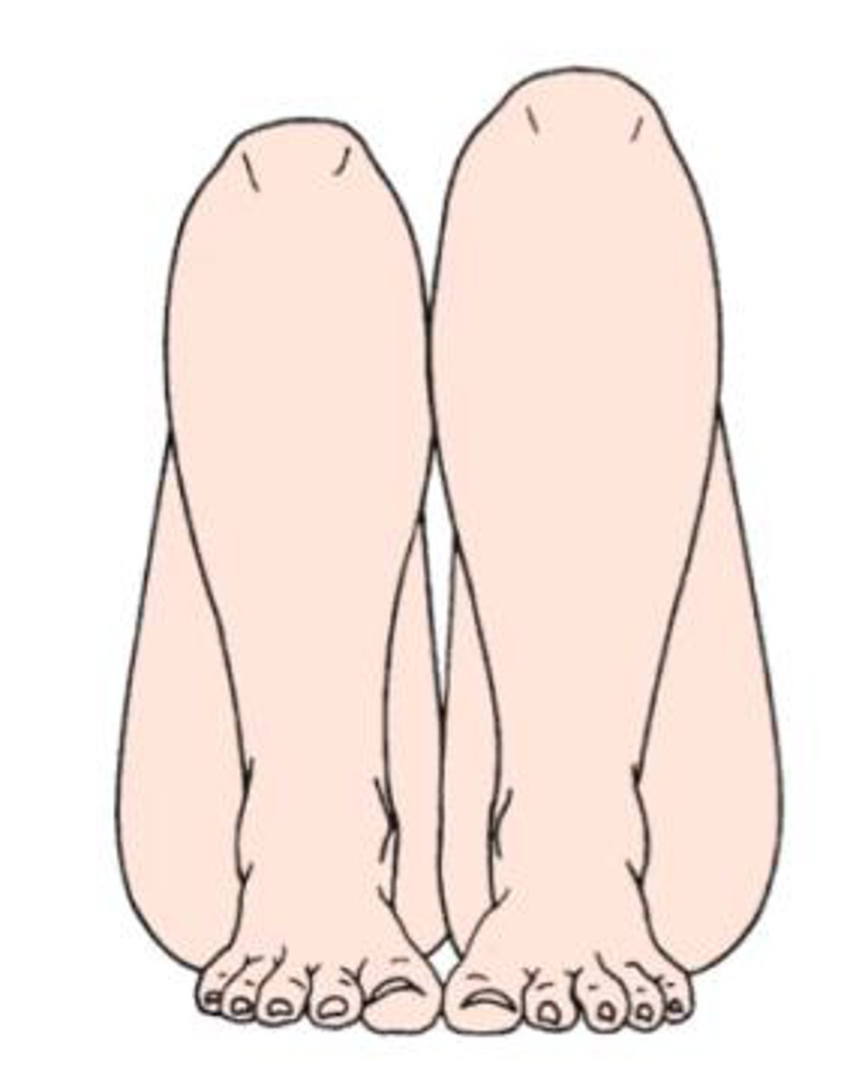 <p>- diagnosis: DDH</p><p>- how: flex knees, feet flat on table, observe if knees are same height</p><p>+ = not same height</p>