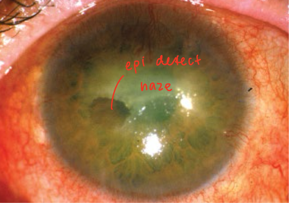 <ul><li><p>complication of Herpes infection of cornea</p></li><li><p><span><strong>Cause</strong>: failure of corneal re-epithelization due to corneal anesthesia</span></p><ul><li><p><span>Exacerbated by drug toxicity and reduction in tear production</span></p></li></ul></li><li><p><span><strong>Presentation</strong>:</span></p><ul><li><p><span>Sterile infiltrate with overlaying epithelial defect</span></p></li><li><p><span>Borders will be <em>smooth</em></span></p></li><li><p><span>Stroma under the defect is grey and opaque</span></p><ul><li><p>stromal will thin</p></li></ul></li><li><p><span>central, interpalpebral</span></p></li></ul></li><li><p><span><strong>Complications</strong>:</span></p><ul><li><p><span>Secondary bacterial infection</span></p></li><li><p><span>Corneal thinning with perforation</span></p></li><li><p><span>Scarring</span></p></li><li><p><span>Neovascularization</span></p></li></ul></li><li><p><strong>Treatment</strong>:</p><ul><li><p><span>Discontinue medication if related to drug toxicity</span></p></li><li><p><span>Preservative free artificial tears</span></p></li><li><p><span>Cenegermin-bkbj ophthalmic solution (Oxervate)</span></p></li><li><p><span>Bandage contact lens</span></p></li><li><p><span>Amniotic membrane</span></p></li><li><p><span>Tarsorraphy</span></p></li><li><p><span>Preservative free topical antibiotic for secondary infection</span></p></li></ul></li></ul><p></p>