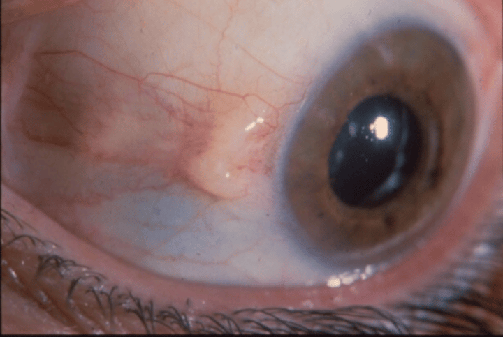 <p>Bulging bump from eye</p>
