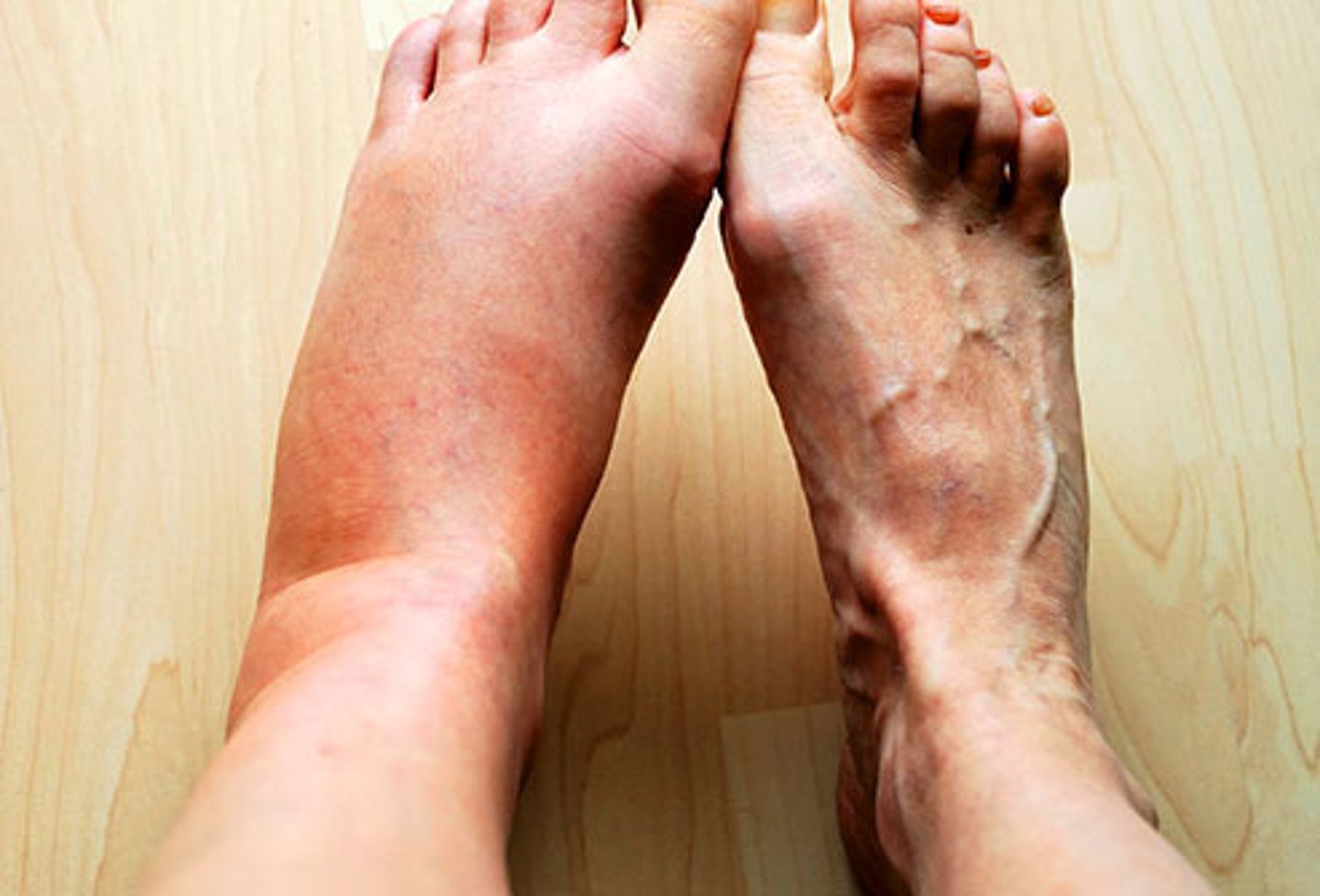 <p>inflammation</p>