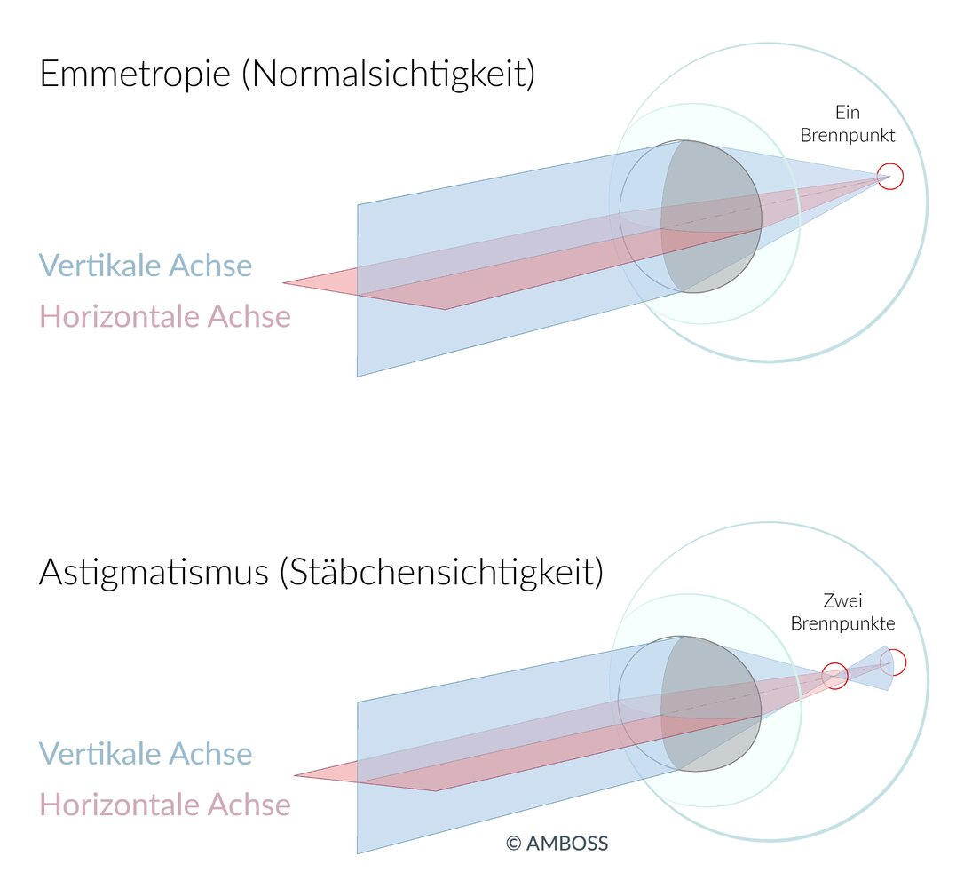 <p>E. The curvature of the cornea is irregular.</p>