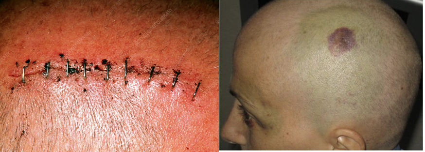 <p>Trauma from abrasion, contusion, laceration, or subgaleal hematoma.</p><ul><li><p>Minor injury but can  bleed profusely due to poor blood vessel constriction.</p></li><li><p>Large avulsion (injury) → possibly life-threatening.</p></li></ul><p></p>