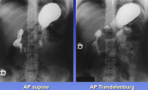 <p>What is this x-ray demonstrating?</p>