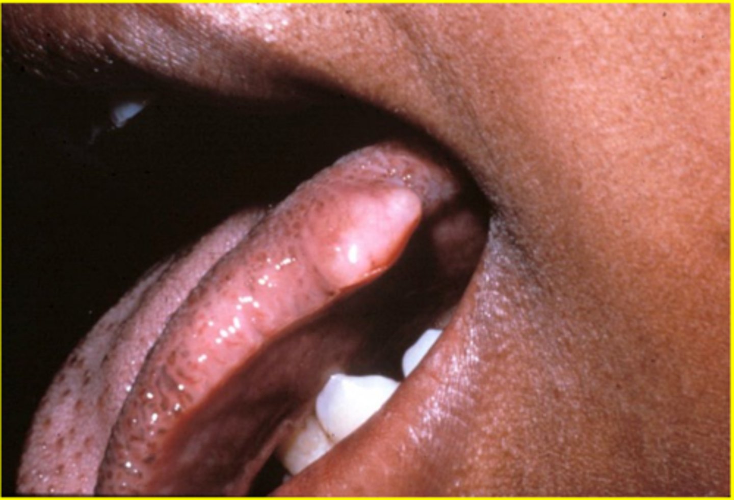 <p>MOST COMMON NERVE TUMOR!!!</p><p>• soft, painless, well-defined nodule </p><p>• associated with neurofibromatosis</p><p>• common locations: tongue, buccal mucosa </p>