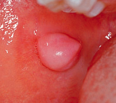 <p><span>refers to a </span><span style="color: red;"><span>reactive overgrowth of fibrous tissue</span></span><span> and is </span><span style="color: red;"><span>not</span></span><span> a true neoplasm</span></p><ul><li><p><strong>cause / history:</strong></p><ul><li><p>patients usually report a history of trauma in the area</p></li><li><p>in such cases, the term <span style="color: red;"><span>"traumatic fibroma" </span></span>is widely used</p></li></ul></li></ul><ul><li><p><strong>management:</strong></p><ul><li><p><span style="color: red;">excisional biopsy</span> should be considered if the lesion is unsightly, repeatedly traumatized, or habitually manipulated by the patient</p></li><li><p>excisional biopsy is <span style="color: red;">more recommended</span> than incisional biopsy</p></li></ul></li></ul><p></p>