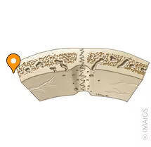<p>Lámina/tabla externa e interna</p><ul><li><p>Compacto</p></li><li><p>Lámina externa siendo la más cercana a la superficie cutánea del cráneo</p></li><li><p>Lamina interna la más cercana al cerebro</p></li></ul><p>Diploë</p><ul><li><p>Tejido esponjoso del cráneo</p></li><li><p>Entre las láminas/tablas</p></li></ul><p></p>