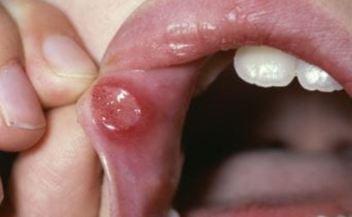 <p><span style="font-family: Droid Sans Mono, monospace">APHTHOUS STOMATITIS</span></p>