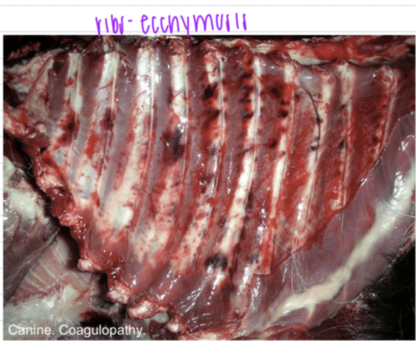 <p>large hemorrage</p>