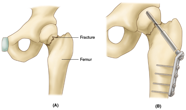 <p>also known as <strong><em>open reduction internal fixation</em></strong> (ORIF), is a fracture treatment in which a plate or pins are placed directly into the bone to hold the broken pieces in place. This form of fixation is <em>not</em> usually removed after the fracture has healed</p>
