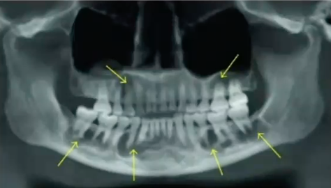 <p>typically found in middle-aged <strong>African American women</strong>, <strong>vital teeth</strong> and <strong>asymptomatic</strong> radiographic findings. </p>