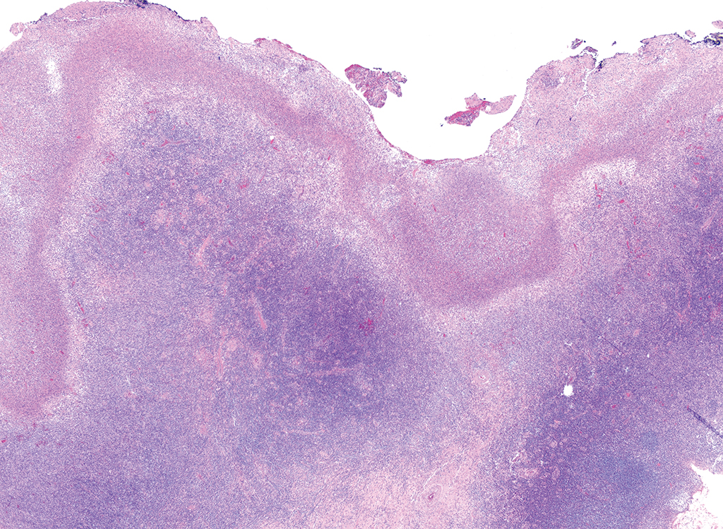 <p>Patient avec ulcère douloureux de la peau </p><p>1) Diagnostic</p><p>2) Localisation</p><p>3) population</p><p>4) Histo </p><p>5) IHC </p>