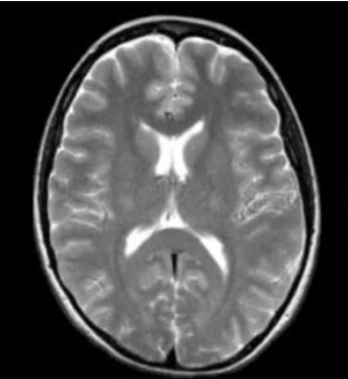 <p>Which type of CT contrast highlights <strong>fluid and pathology</strong>: <strong>water is bright</strong>, fat is bright</p>