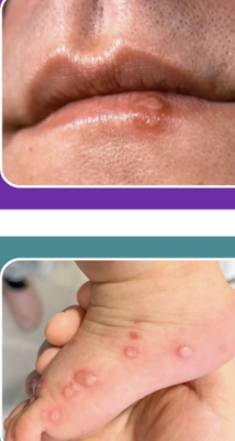 <p><u>HSV</u></p><p>• Any age, recurrent (reactivation), common</p><p>• Prodrome of pain/burning/tingling</p><p>• Lesions surround each other at 1 spot</p><p>• Can have high fever</p><p>• Lesions very painful</p><p>• Can confirm with PCR or Tzanck smear (multinucleated giant cells)</p><p><u>HFMD</u></p><p>• Kids usually, palms, soles, around mouth; buttocks sometimes</p><p>• May have prodrome of sore throat, decreased appetite</p><p>• Low-grade or no fever</p><p>• Lesions “shallow” and “grey”; not as painful as HSV</p>