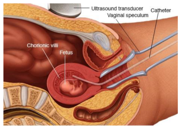 <p>Test a sample of the parents blood. If 1 or neither are carriers, the child won’t have sickle cell. If both are carriers, you can use Chorionic Villous Sampling (@ 9-10 weeks) or amniocentesis (test amniotic fluid @ 15-18 weeks)</p>