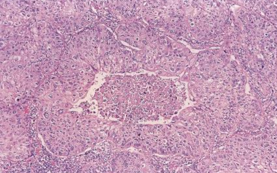 <p>Carcinoma de células escamosas, nivel de diferenciación</p>