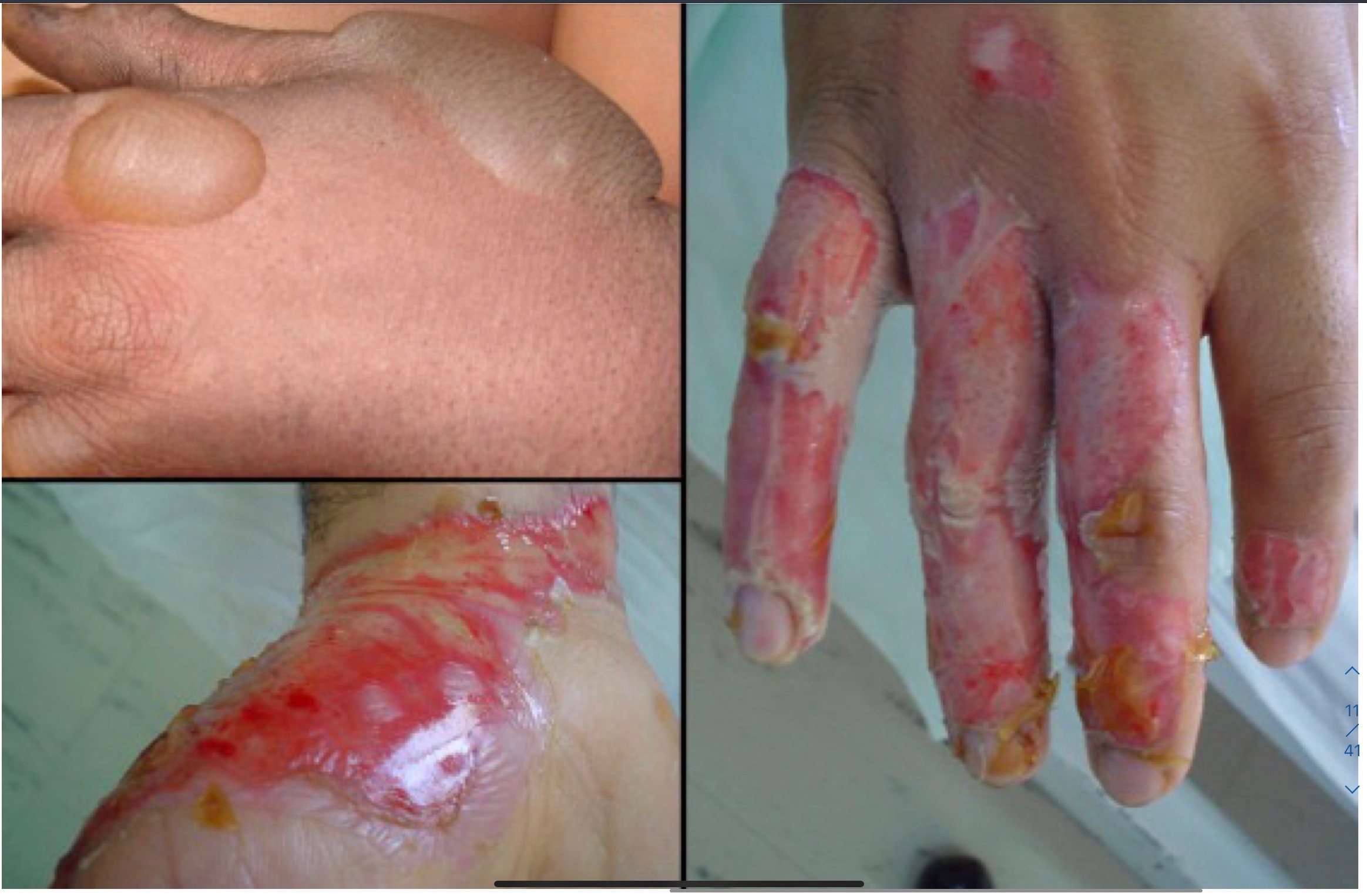 what is a blister and where is it formed?