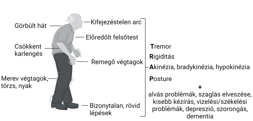 <p>kifejezéstelen arc</p><p>Görbült hát</p><p>Előredőlt felsőtest</p><p>Csökkent karlengés</p><p>Remegő végtagok</p><p>Merev végtagok, törzs, nyak</p><p>T: tremor, R:igiditás, A: akinézia, bradykinézia, hypokinézia, P:posture</p>