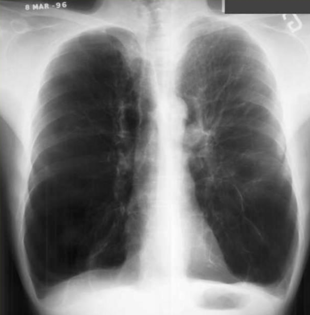 <p>COPD/Emphysema: CXR</p>