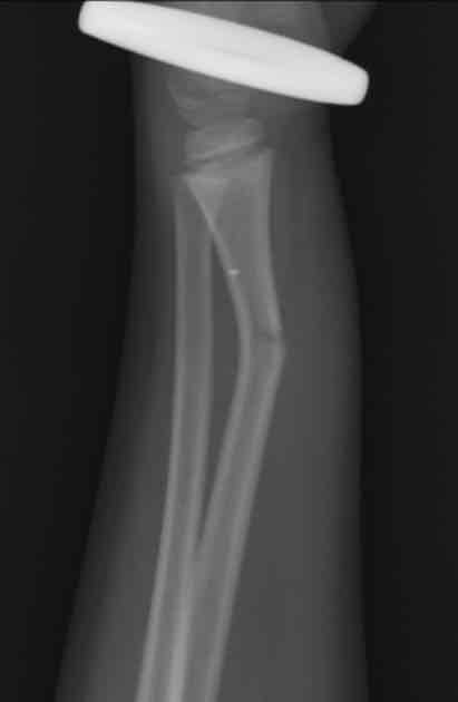 <p>Bone bends &amp; cracks, often seen in children to more flexible bones</p>