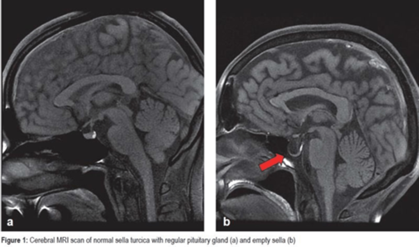 <p>Define Cause of Hypopituitarism:</p><p>Herniation of Arachnoid and CSF into Sella Turcica</p><p>-Hx:</p><p>&gt; Idiopathic (a/w Idiopathic Intracranial HTN)</p><p>&gt; More in Females</p><p>-Path: Compresses and DESTROYS PITUITARY GLAND</p><p>-Dx: (Imaging)</p><p>&gt; ABSENT Pituitary Gland (Empty Sella Turcica)</p>