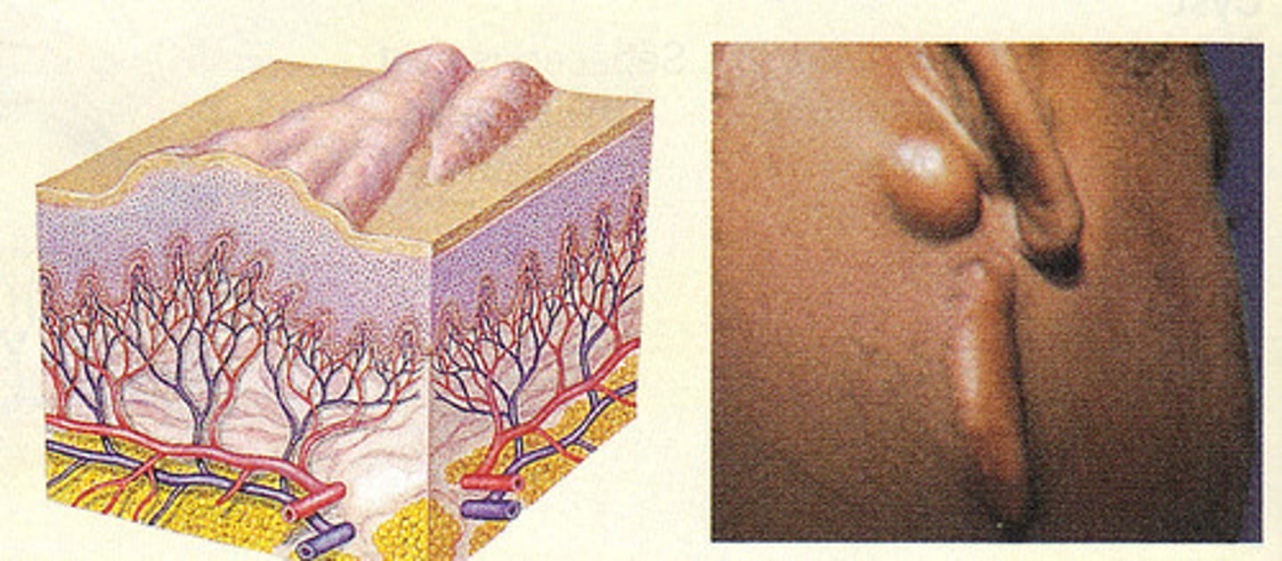 <p>Irregularly shaped, elevated and enlarging scar that grows beyond the boundaries of the wound</p><p>Usually due to excessive collagen formation during healing</p>