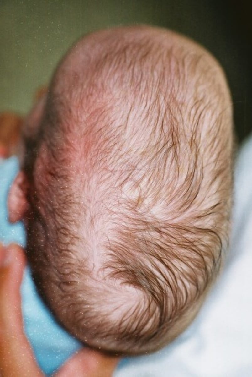 <p>scaphocephaly → "hull" shaped skull</p>