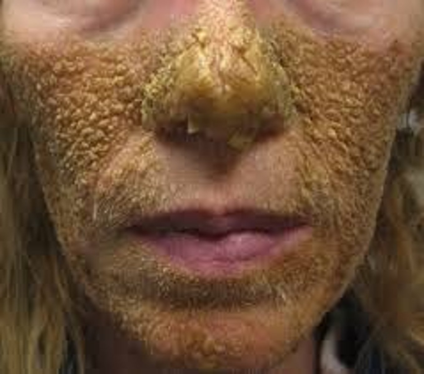 <p>hereditary factor in which dead skin cells build up</p>