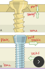 <ul><li><p><span style="background-color: transparent;"><strong><span>Classified:</span></strong><span> by</span><strong><span> </span><u><span>outer diameter</span></u></strong></span></p></li><li><p><span style="background-color: transparent;"><strong><span>Types</span></strong><span>: Stainless steel or titanium, partially or fully threaded, Locking vs. non-locking</span></span></p><ul><li><p><span style="background-color: transparent;"><strong><span>standard Non-locking</span></strong><span>: rely on </span><u><span>bone–plate friction</span></u></span></p></li><li><p><span style="background-color: transparent;"><strong><span>Locking</span></strong><span>: screw head threads into plate, </span><u><span>plate/screw interface</span></u></span></p><ul><li><p><span style="background-color: transparent;"><span>fixed-angle stability</span></span></p></li></ul></li><li><p><strong>Individual</strong>: lag screw </p></li></ul></li></ul><p></p>