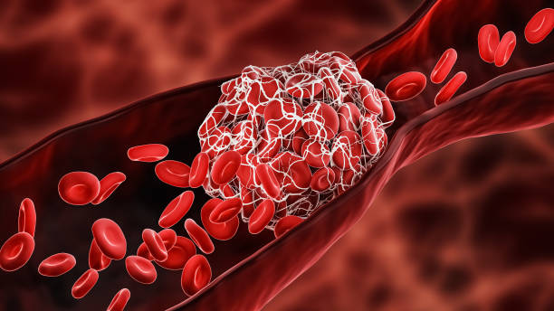 <p>clot</p>