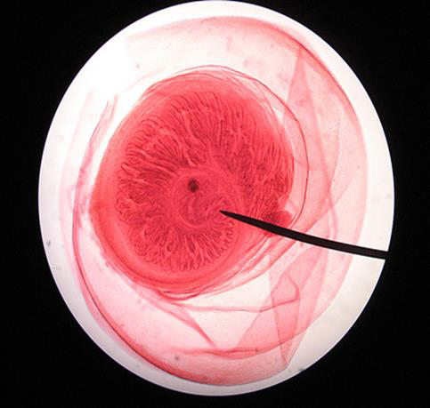 <p><strong>Identify this parasitic stage, its adult parasite, and mention the type of brain lesion it produces.</strong></p><ul><li><p><em>Cysticercus cellulosae</em></p></li><li><p>Adult parasite: <em>Taenia solium</em></p></li><li><p>Brain lesion: <strong>Cystic lesion (cysticercosis)</strong></p></li></ul><p><strong>What is the definitive diagnostic technique?</strong></p><ul><li><p><strong>Excision biopsy</strong></p></li></ul><p><strong>Mention two morphological characteristics of this stage.</strong></p><ul><li><p>About <strong>5 × 10 mm</strong>, bladder-like (contains fluid)</p></li><li><p><strong>Scolex invaginated</strong> with 4 suckers and double rows of hooks</p></li></ul><p></p>