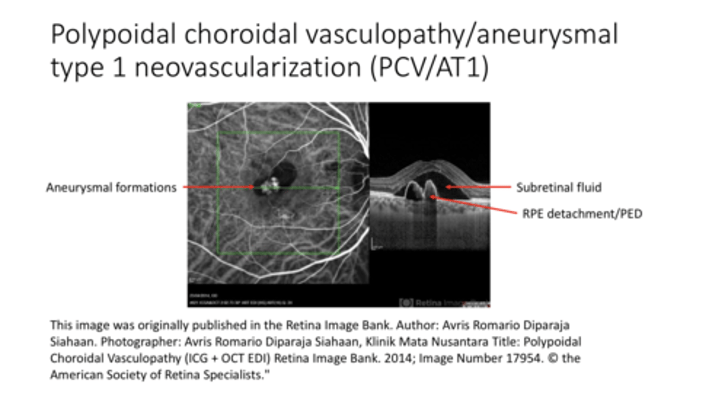 <p>Polypoidal Choroidal Vasculopathy/Aneurysmal Type 1 Neovascularization (PCV/AT1)</p>