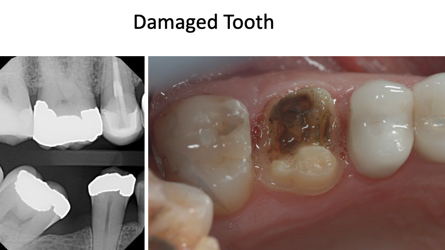 <p>what restoration would we do on this MOD fractured tooth?</p>