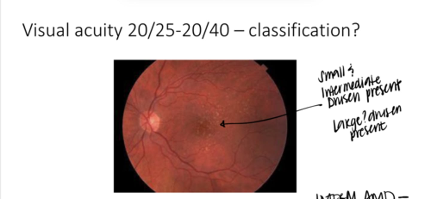 <p>What form of AMD is this pic?</p>