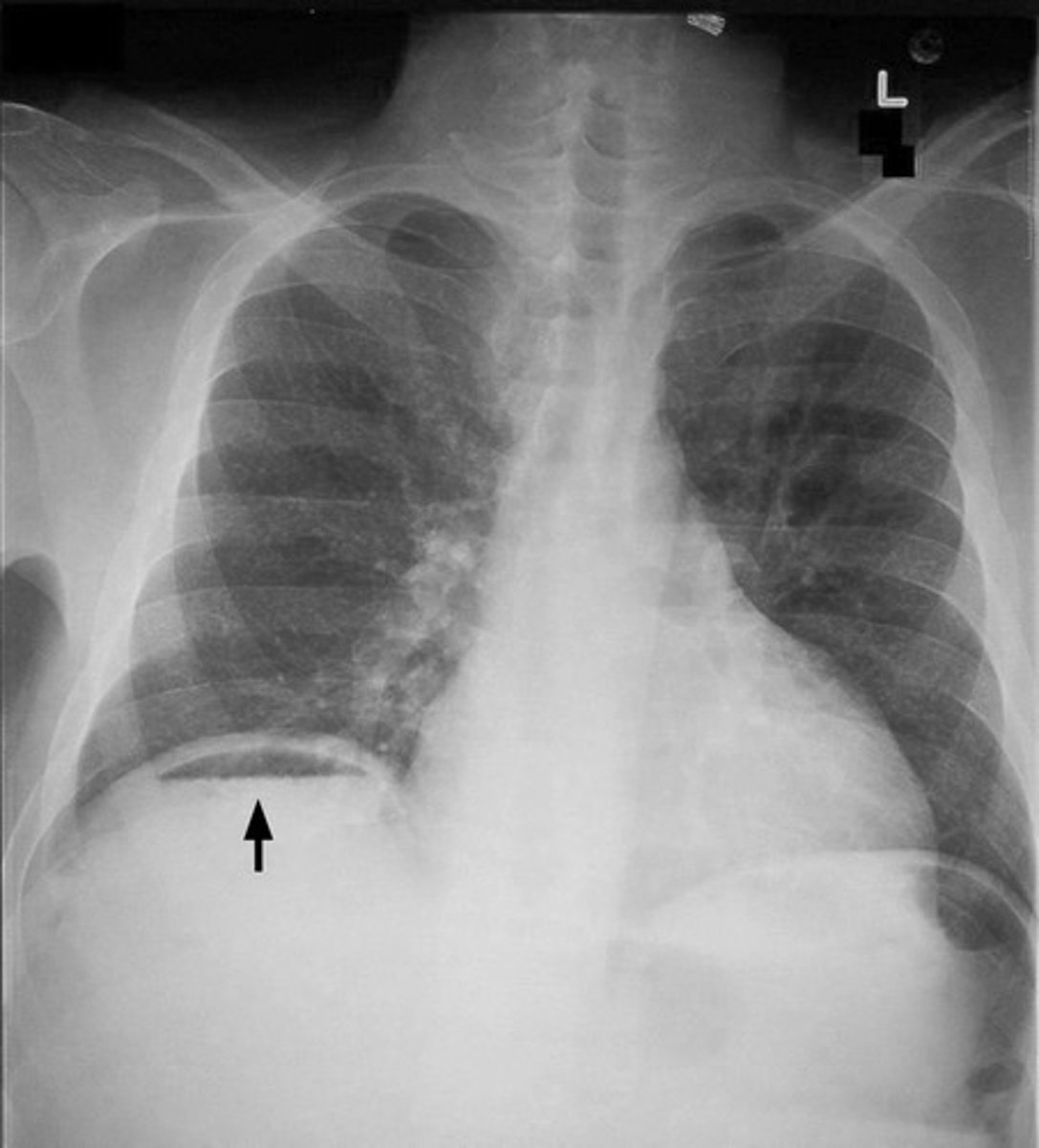 <p>Free air or gas in the peritoneal cavity</p>