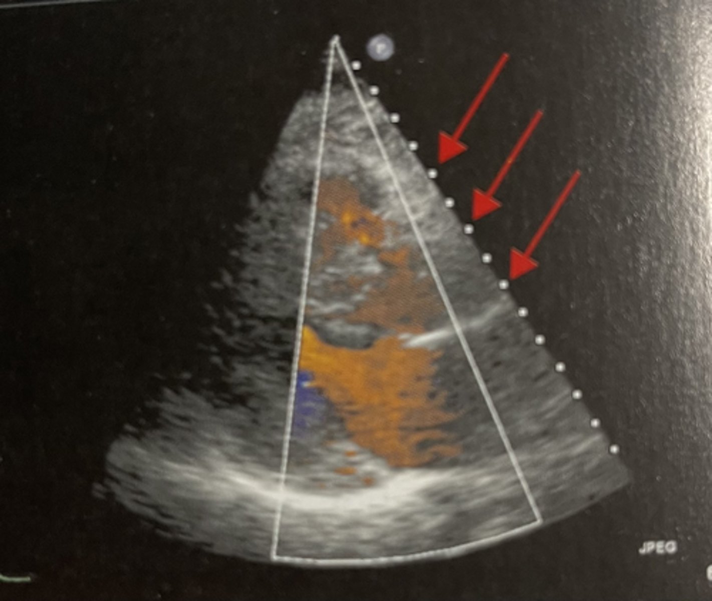 <p>maximum distance into the body that an ultrasound system is imaging</p>
