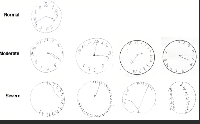 <p>What Counts as a “Clock Error”? </p><p class="">Examples of clock errors that raise a red flag:</p><ul><li><p class="">Numbers are <strong>missing, jumbled</strong>, or <strong>not spaced correctly</strong></p></li><li><p class="">All numbers are on <strong>one side</strong> of the clock</p></li><li><p class="">Hands point to <strong>the wrong time</strong></p></li><li><p class="">Hands are <strong>not clearly distinguishable</strong> (no difference in length)</p></li><li><p class="">They draw <strong>random shapes or scribbles</strong></p></li><li><p class=""><strong>No numbers</strong> at all</p></li></ul><p>These errors may suggest <strong>early dementia</strong>, <strong>Alzheimer’s</strong>, or other <strong>cognitive decline</strong>—especially when combined with poor word recall from the Mini-Cog test.</p>
