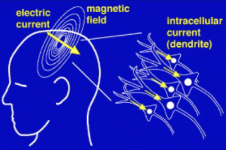 <p>measures magnetic fields created by flow of ion currents between neuron with magnetometers (superconducting quantum interference devices (SQUID))</p><ul><li><p>see where activity is occurring in the brain</p></li><li><p>not good at seeing activity deep in the brain</p></li></ul><p></p>